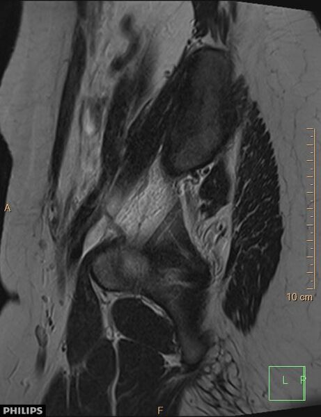 File:Cesarian scar endometriosis (Radiopaedia 68495-78066 Sagittal T2 2).jpg