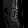 Chance fracture with duodenal and pancreatic lacerations (Radiopaedia 43477-50042 Sagittal bone window 12).jpg