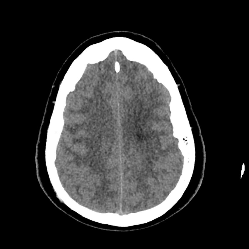 Chiasmatic-hypothalamic juvenile pilocytic astrocytoma (Radiopaedia 78533-91237 Axial non-contrast 44).jpg