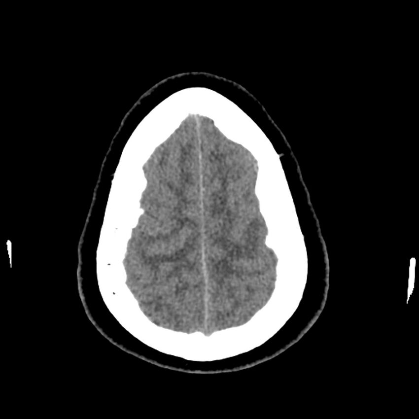 Chiasmatic-hypothalamic juvenile pilocytic astrocytoma (Radiopaedia 78533-91237 Axial non-contrast 49).jpg