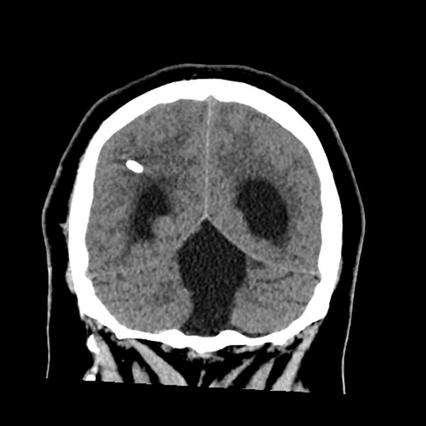 File:Chiasmatic-hypothalamic juvenile pilocytic astrocytoma (Radiopaedia 78533-91237 Coronal non-contrast 54).jpg