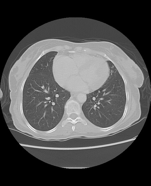 File:Chondrosarcoma (Radiopaedia 79427-92532 Axial lung window 38).jpg