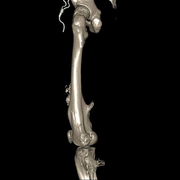 File:Chondrosarcoma arising from exostosis (Radiopaedia 59996-67507 3D Reconstruction 4).jpg