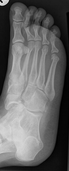 File:Chopart fracture (Radiopaedia 12386-12649 Oblique 1).jpg