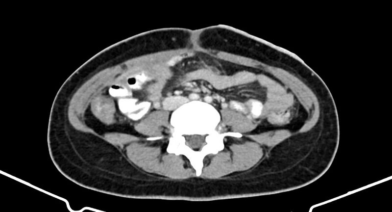 File:Choriocarcinoma liver metastases (Radiopaedia 74768-85766 A 129).jpg