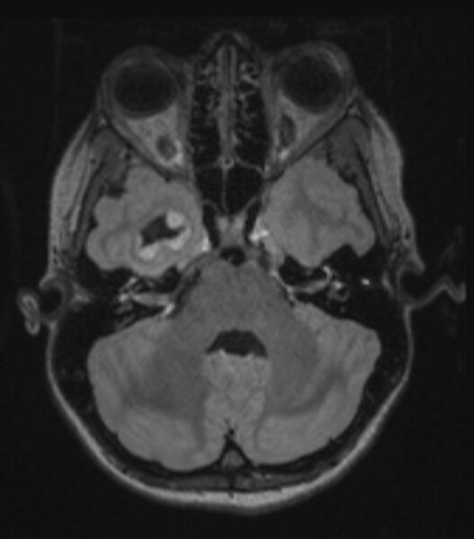 File:Choroid plexus carcinoma (Radiopaedia 91013-108553 Axial FLAIR C+ 97).jpg