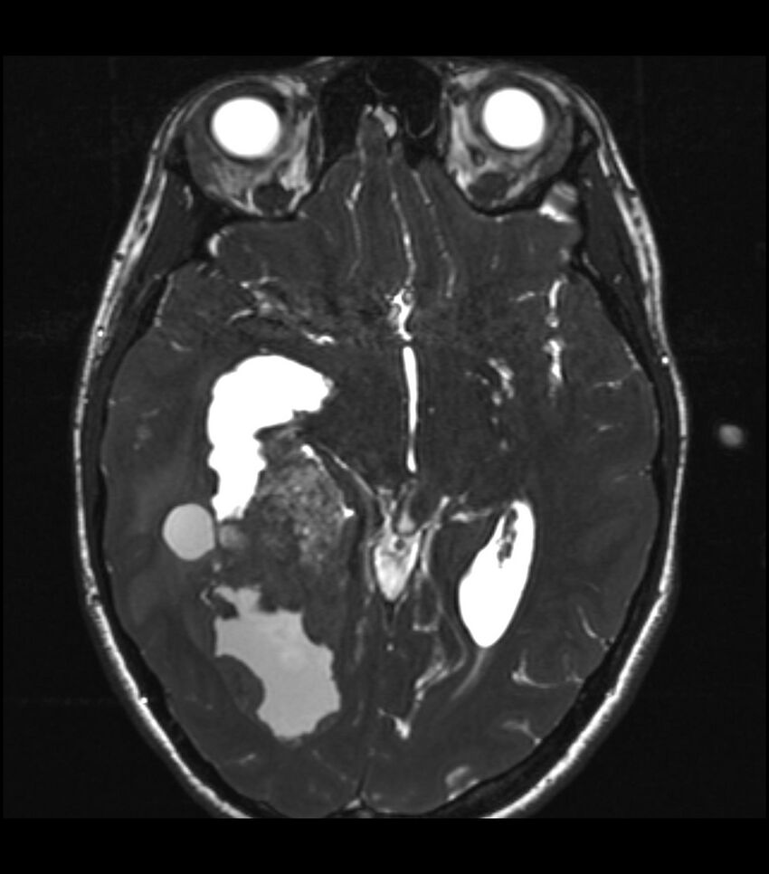 Choroid plexus carcinoma (Radiopaedia 91013-108553 Axial T2 CISS 28).jpg