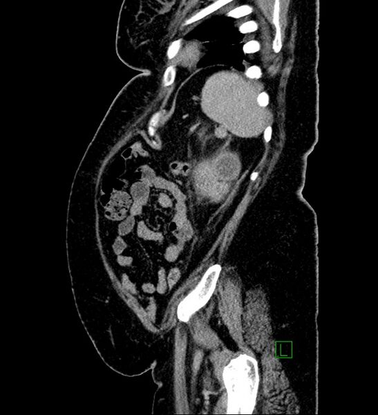 File:Chromophobe renal cell carcinoma (Radiopaedia 84239-99519 G 24).jpg