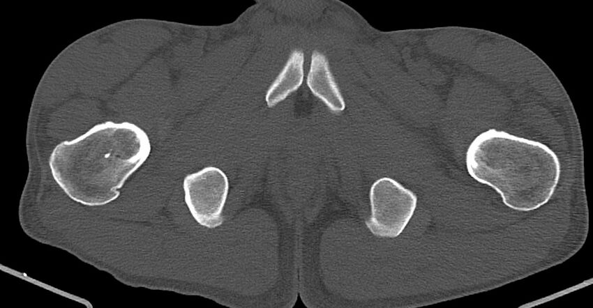 Chronic osteomyelitis (with sequestrum) (Radiopaedia 74813-85822 Axial non-contrast 50).jpg