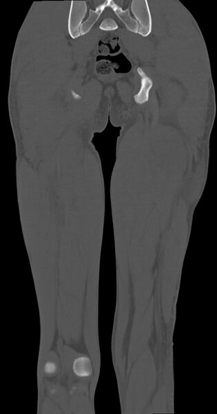 File:Chronic osteomyelitis (with sequestrum) (Radiopaedia 74813-85822 Coronal non-contrast 43).jpg