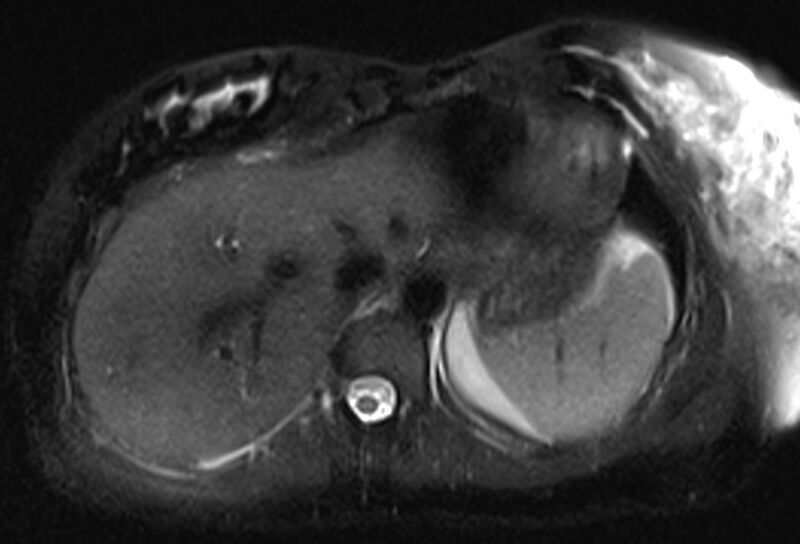 File:Chronic pancreatitis - pancreatic duct calculi (Radiopaedia 71818-82250 Axial T2 fat sat 9).jpg