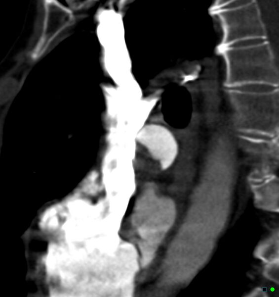 File:Chronic pulmonary embolism (Radiopaedia 17943-17702 Sagittal C+ CTPA 16).jpg