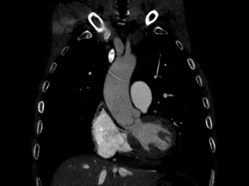File:Chronic pulmonary embolism (Radiopaedia 91241-108843 A 32).jpg