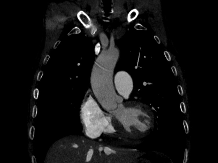 Chronic pulmonary embolism (Radiopaedia 91241-108843 A 32).jpg