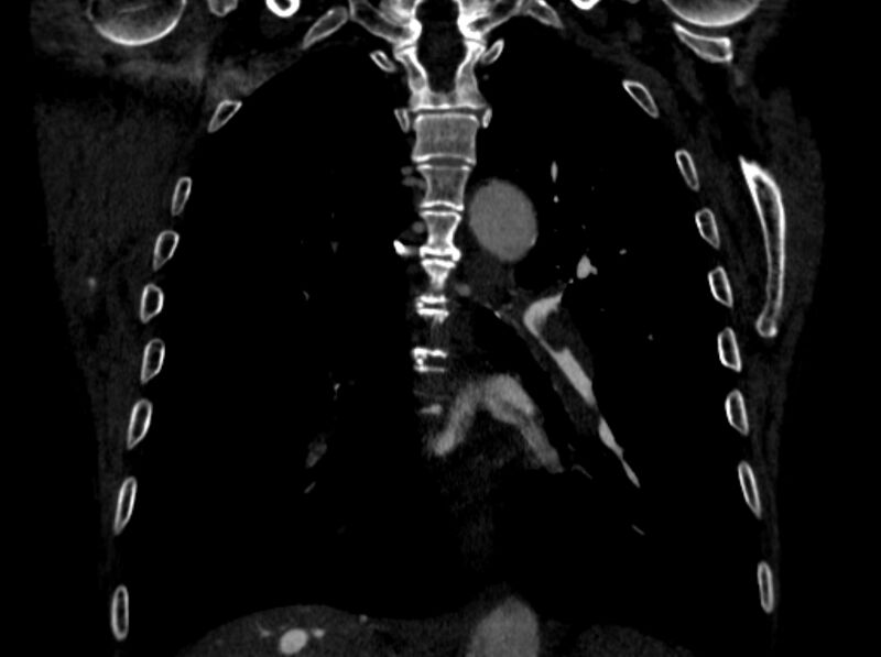 File:Chronic pulmonary embolism (Radiopaedia 91241-108843 A 70).jpg
