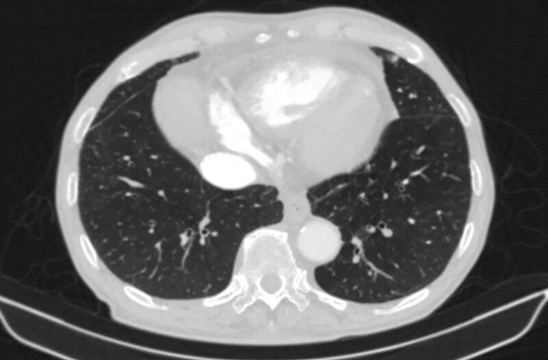 File:Chronic pulmonary embolism (Radiopaedia 91241-108843 Axial lung window 71).jpg