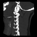 Clay-shoveler fracture (Radiopaedia 22568-22590 Sagittal MIP 3).jpg