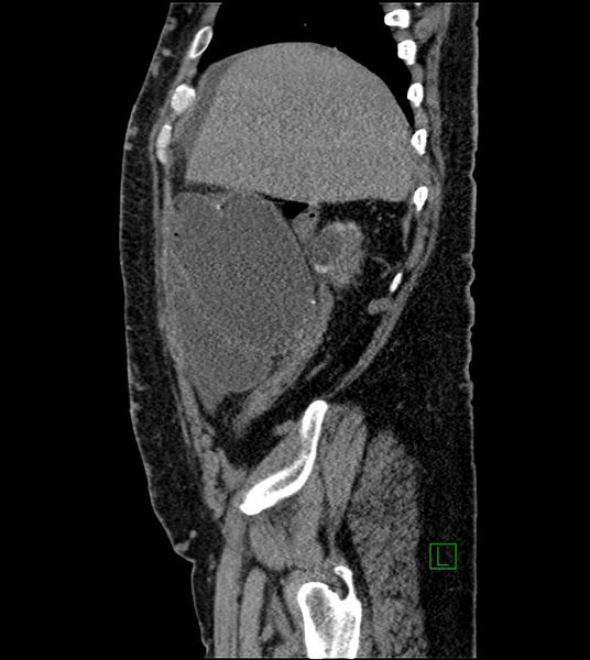 File:Closed-loop small bowel obstruction-internal hernia (Radiopaedia 78439-91096 C 115).jpg