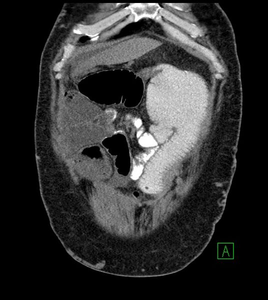 File:Closed-loop small bowel obstruction-internal hernia (Radiopaedia 78439-91096 Coronal non-contrast 24).jpg