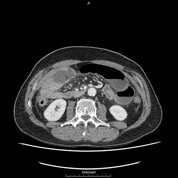 File:Closed loop bowel obstruction and ischemia (Radiopaedia 86959-103180 A 37).jpg