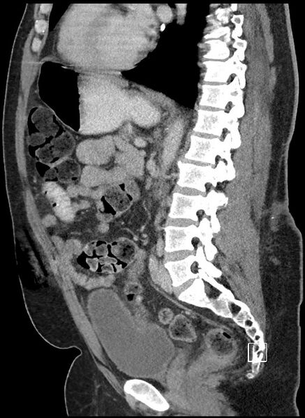 File:Closed loop obstruction - internal hernia into nephrectomy bed (Radiopaedia 59867-67320 C 39).jpg