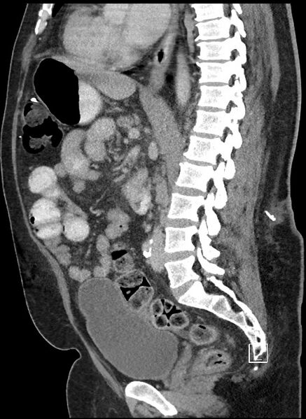 File:Closed loop obstruction - internal hernia into nephrectomy bed (Radiopaedia 59867-67320 C 48).jpg