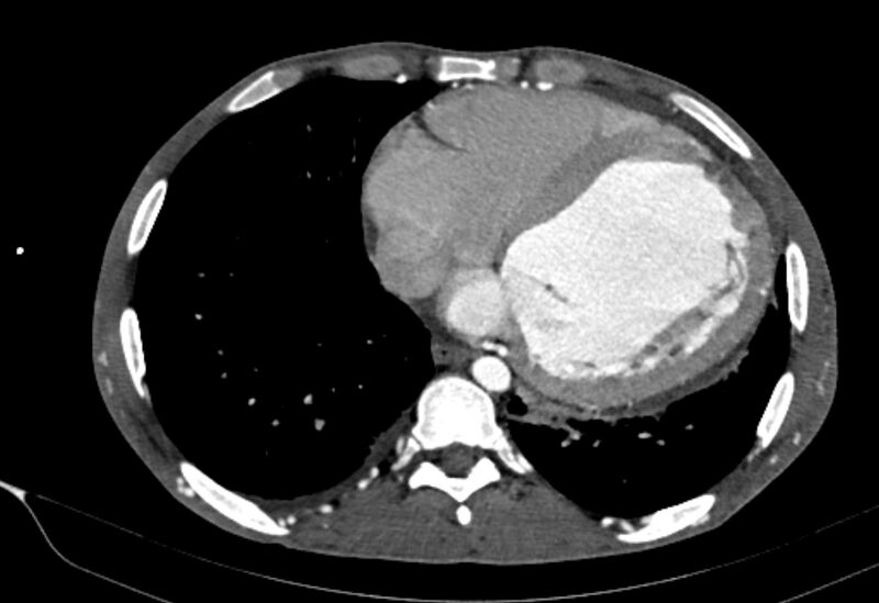 File:Coarctation of aorta with aortic valve stenosis (Radiopaedia 70463-80574 A 156).jpg