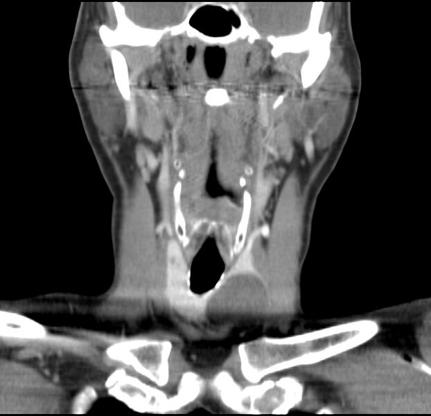 File:Colloid cyst of thyroid (Radiopaedia 22897-22923 Coronal C+ delayed 28).jpg