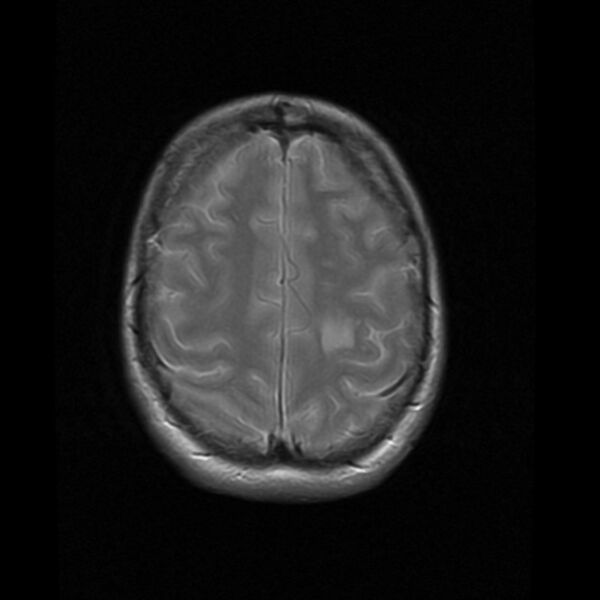 File:Colloid cyst with hydrocephalus (Radiopaedia 9373-10065 Axial PD 16).jpg