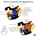 Glomus jugulare paraganglioma (axial view illustration) (Radiopaedia 75522).png