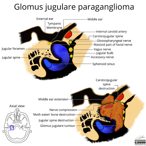 File:Glomus jugulare paraganglioma (axial view illustration) (Radiopaedia 75522).png