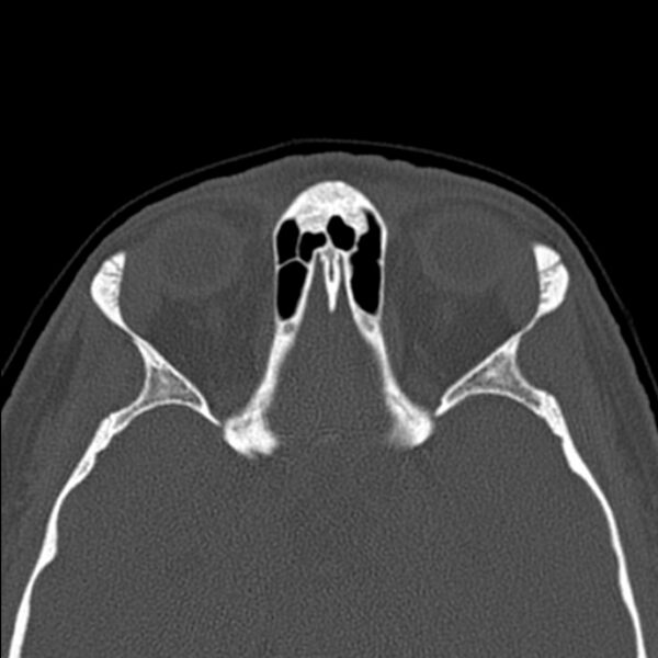 File:Nasal septal perforation (Radiopaedia 25030-25289 Axial bone window 49).jpg