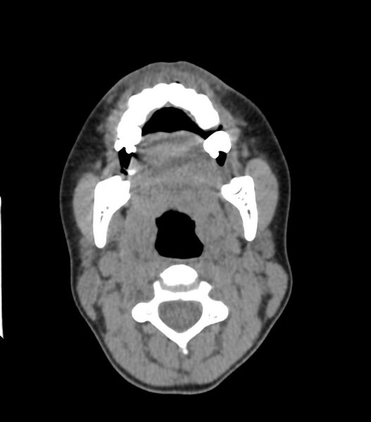File:Nasoorbitoethmoid fracture (Radiopaedia 90044-107205 Axial non-contrast 80).jpg