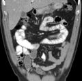 Necrotizing pancreatitis with acute necrotic collection (Radiopaedia 14470-14417 C 8).jpg