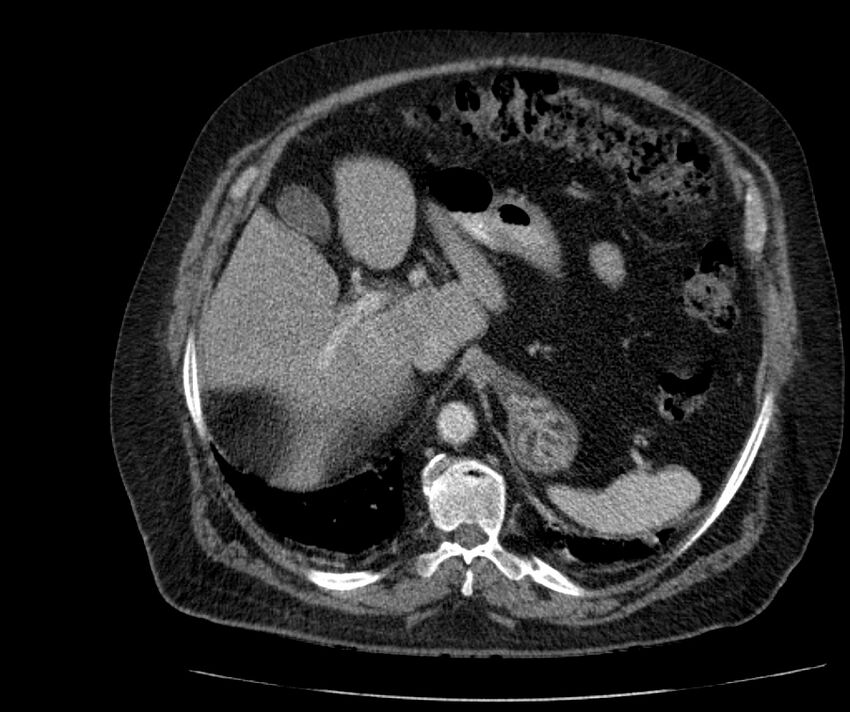 Nephroptosis with inguinal hernia containing perirenal fat (Radiopaedia 56632-63391 C 88).jpg