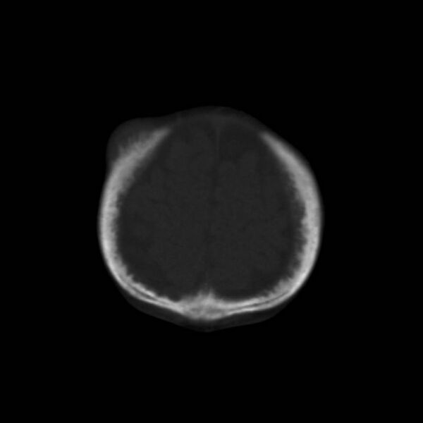 File:Neuroblastoma with skull metastases (Radiopaedia 30326-30958 Coronal bone window 8).jpg