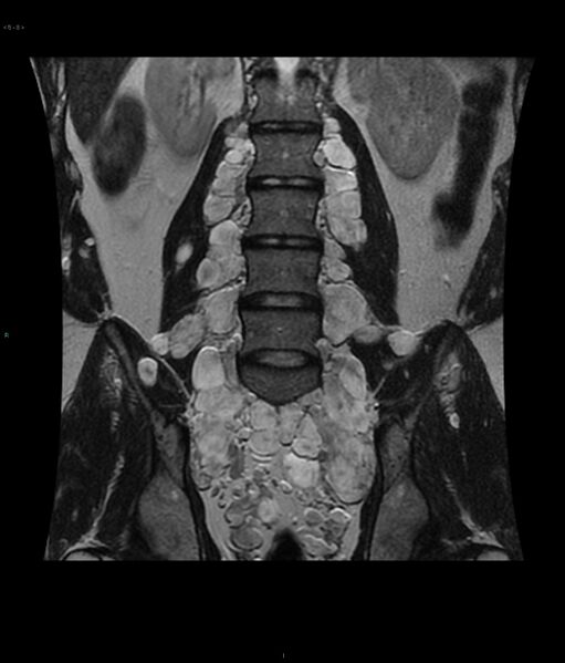 File:Neurofibromatosis type 1 (Radiopaedia 36933-38560 Coronal T2 8).jpg