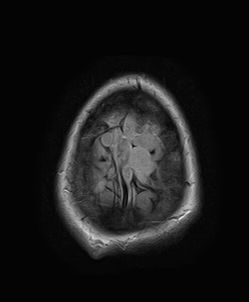 File:Neurofibromatosis type 2 (Radiopaedia 66211-75401 Axial FLAIR 26).jpg