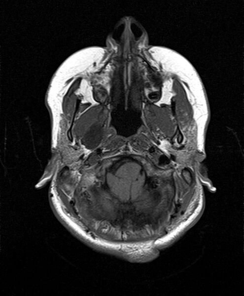 File:Neurofibromatosis type 2 (Radiopaedia 66211-75401 Axial T1 7).jpg