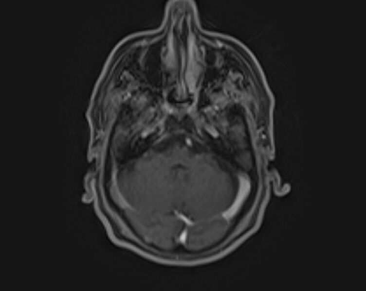 File:Non-Hodgkin lymphoma - parotid gland (Radiopaedia 71531-81890 E 47).jpg