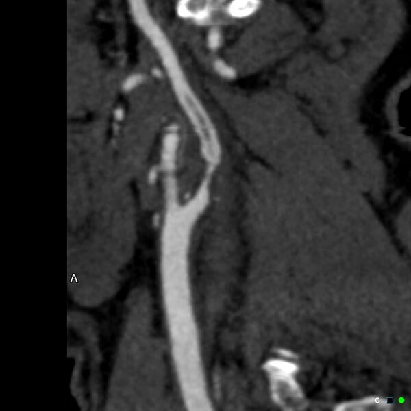 File:Non-occlusive intraluminal internal carotid artery thrombus (Radiopaedia 37751-39658 A 54).jpg