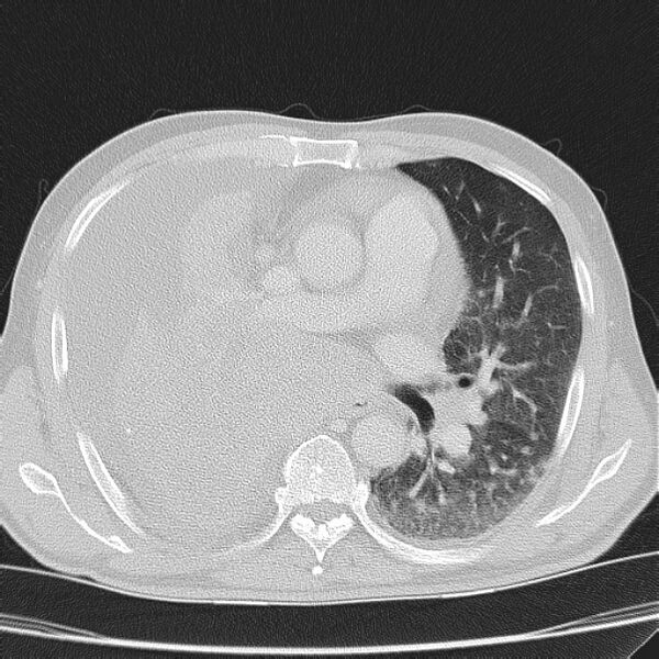 File:Non small-cell lung cancer (Radiopaedia 24467-24769 lung window 24).jpg