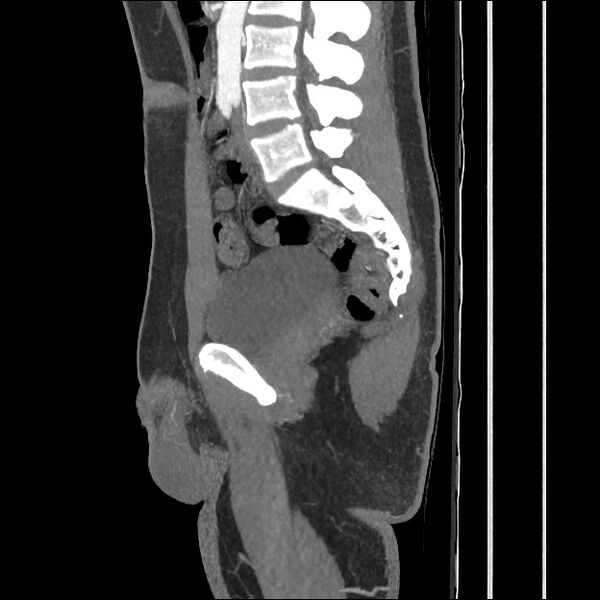 File:Normal CT angiogram of pelvis (Radiopaedia 45390-49430 C 34).jpg