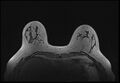 Normal breast MRI - dense breasts (Radiopaedia 80454-93850 Axial T1 63).jpg