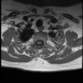 Normal cervical and thoracic spine MRI (Radiopaedia 35630-37156 Axial T1 5).png