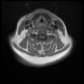 Normal cervical and thoracic spine MRI (Radiopaedia 35630-37156 Axial T1 C+ 17).png