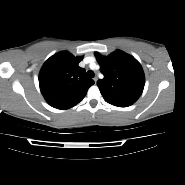 File:Normal dual-phase trauma CT chest,abdomen and pelvis (Radiopaedia 48092-52899 A 14).jpg
