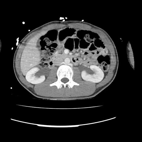 File:Normal dual-phase trauma CT chest,abdomen and pelvis (Radiopaedia 48092-52899 A 66).jpg