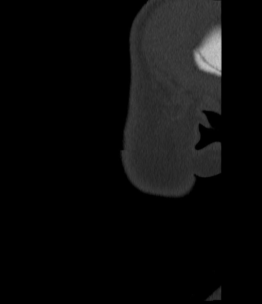 Normal facial bone CT (Radiopaedia 88742-105476 Sagittal bone window 12).jpg