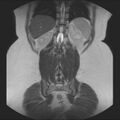Normal liver MRI with Gadolinium (Radiopaedia 58913-66163 Coronal T2 33).jpg